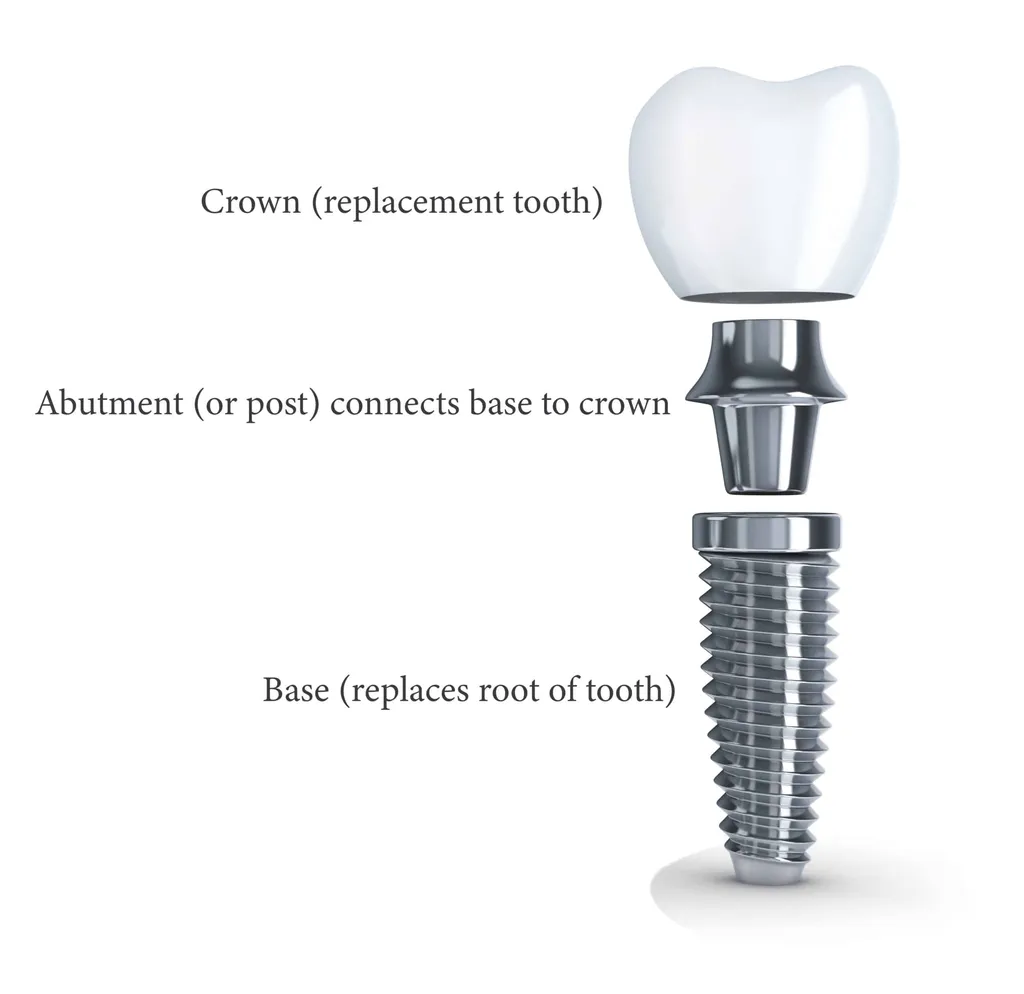 Implant Prosthesis with Locator