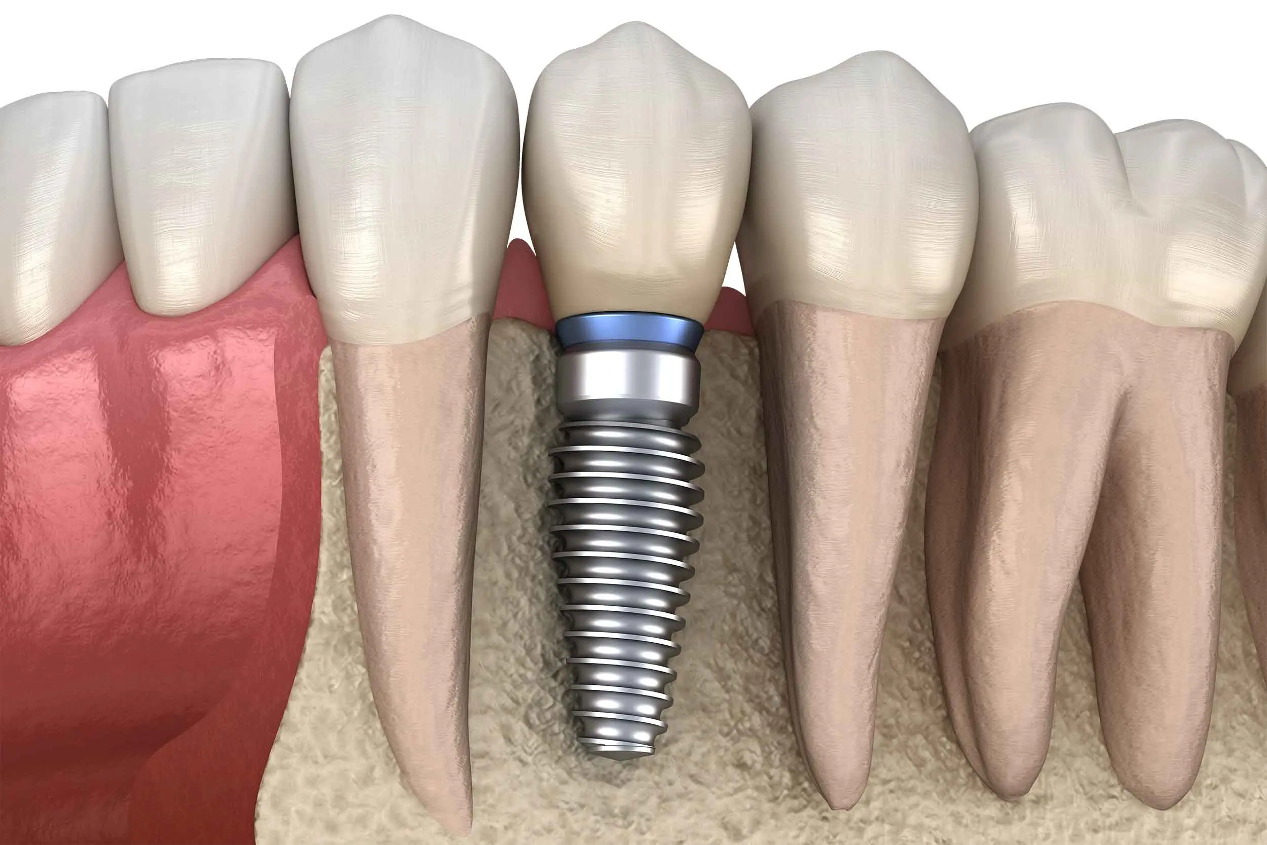 Single Dental Implant