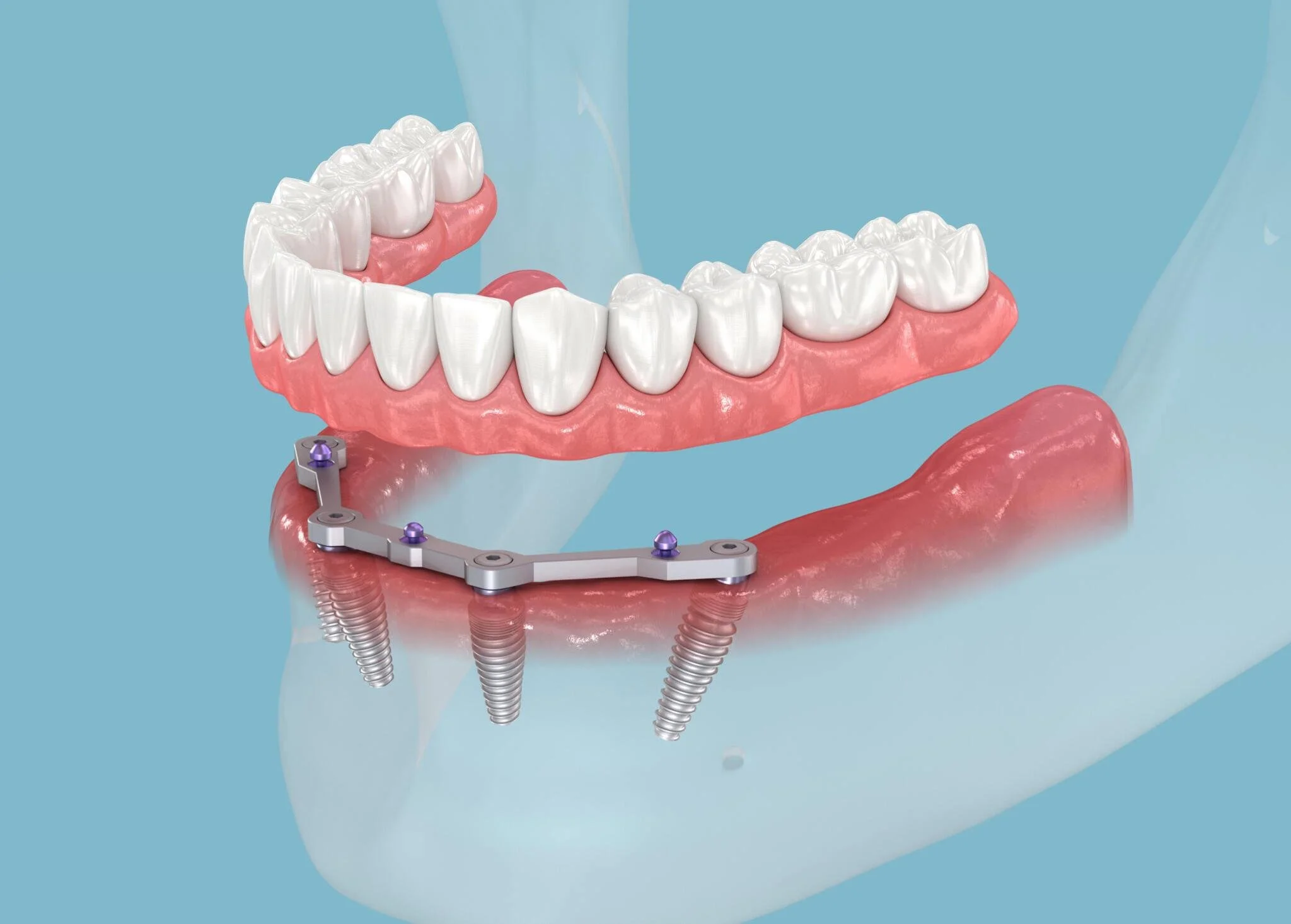 Implant Prosthesis with Bar